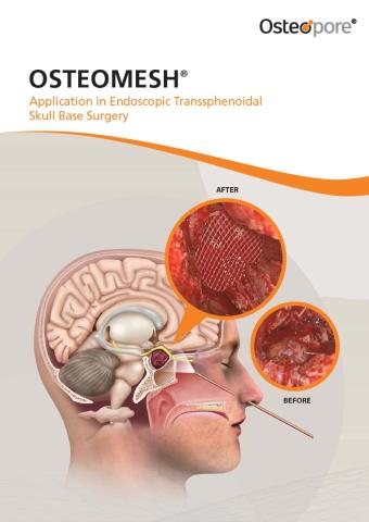 Brochure - Osteomesh Application Endoscopic Transsphenoidal Skull Base Surgery Non-CE