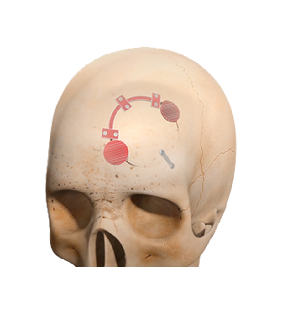 Craniotomy