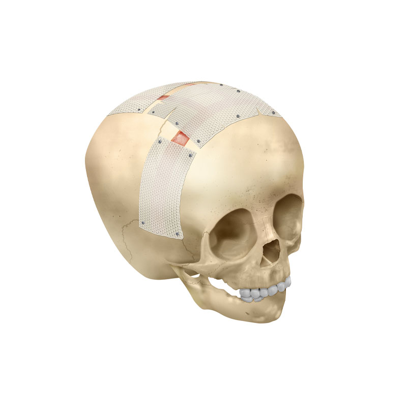 2006 - First-in-human reconstruction Craniosynostosis with Osteomesh