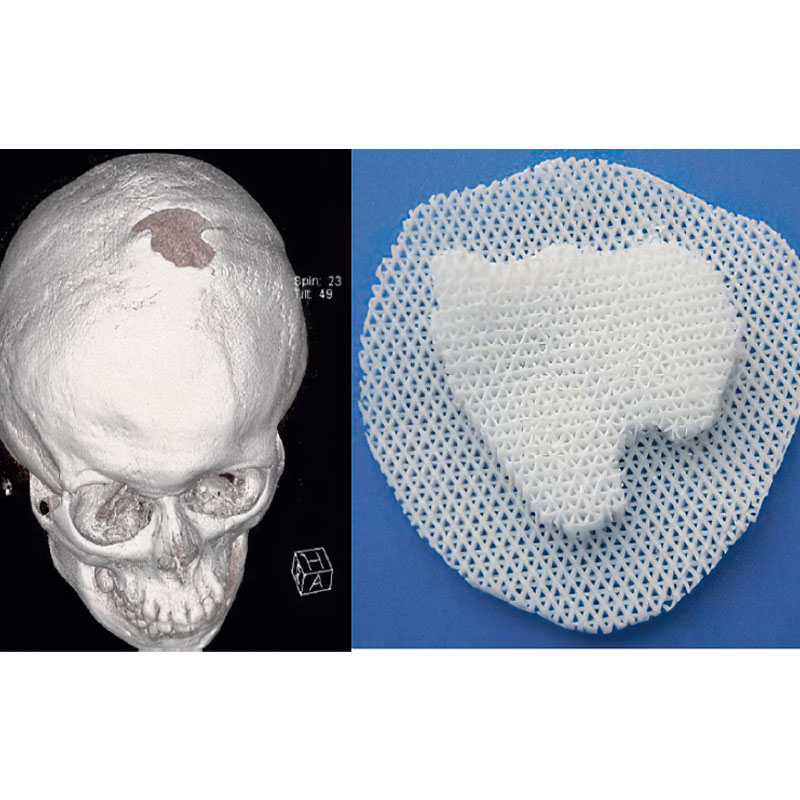 2009 - The first-in-human patient specific implant with PCL-TCP for cranioplasty