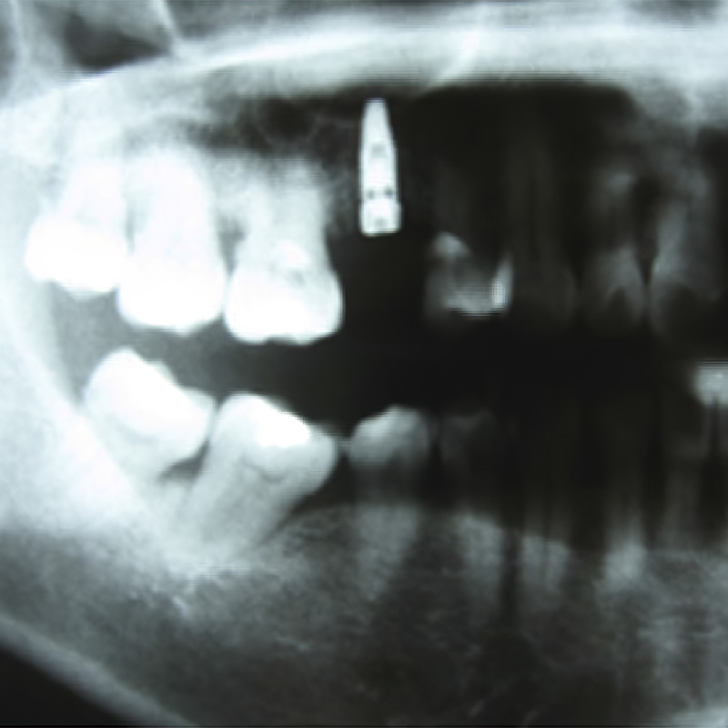 2015 - First clinical trial for socket preservation in dental surgery