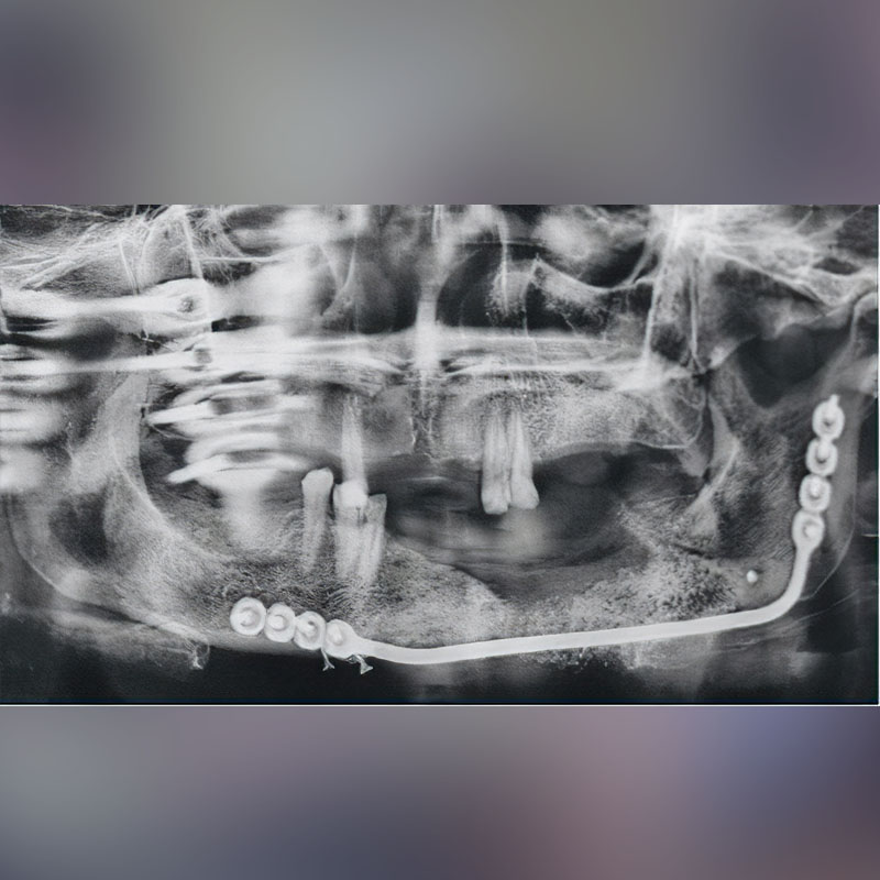 2018 - First mandible reconstruction with Osteomesh