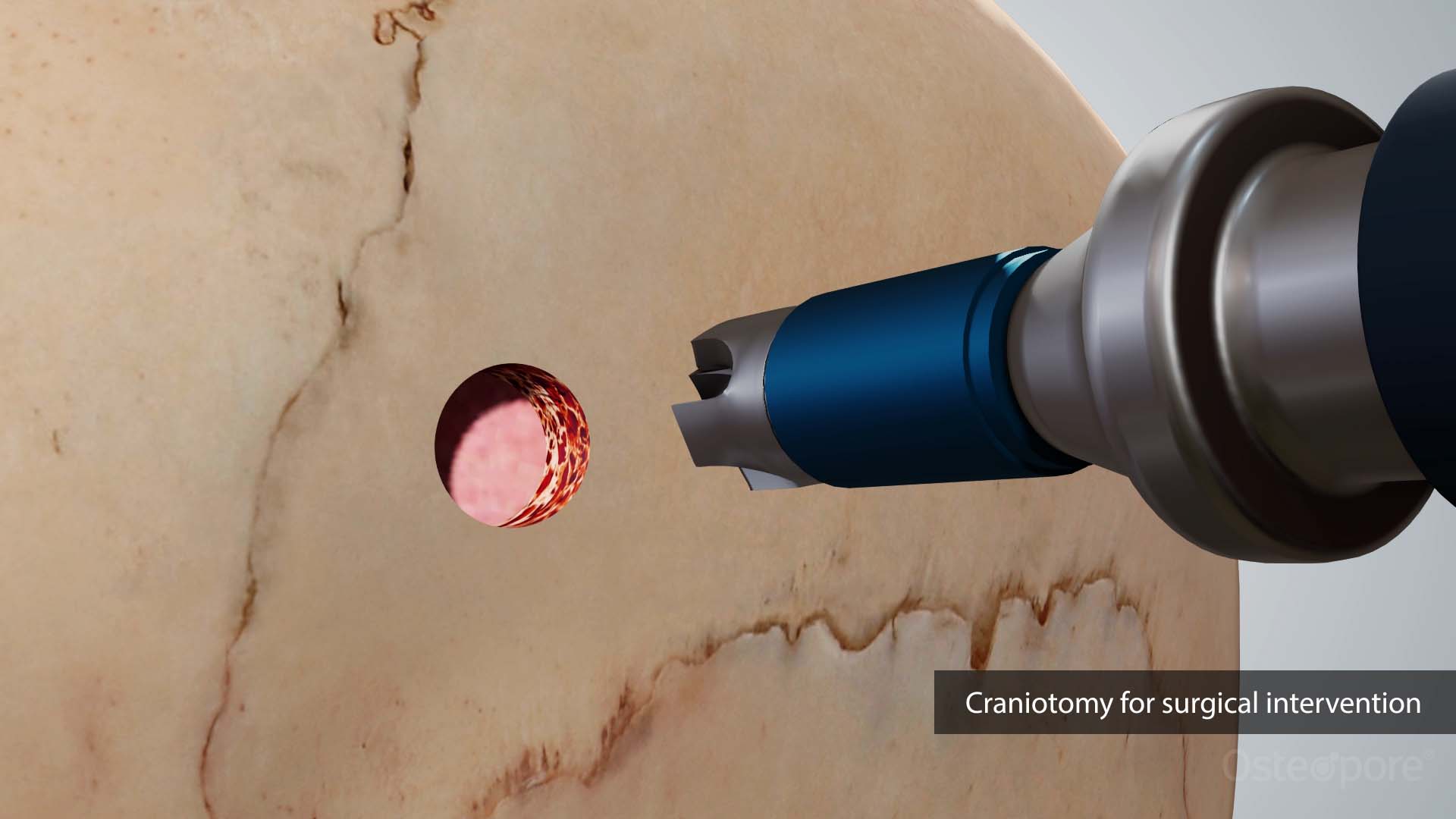 Craniotomy with Osteoplug®